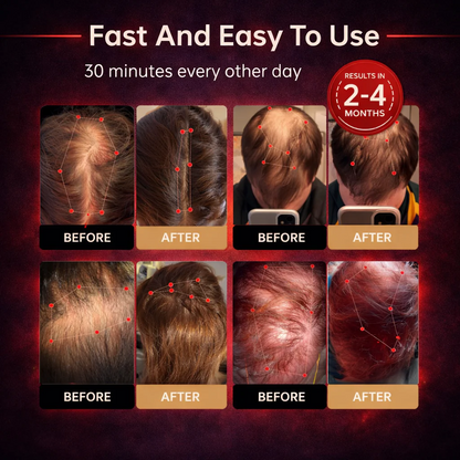 ✨Red Light Therapy Cap, USB Rechargeable Portable Hair Regrowth Cap, Travel Friendly Hair Care Gift for Men & Women💆‍♂️💆‍♀️-FO